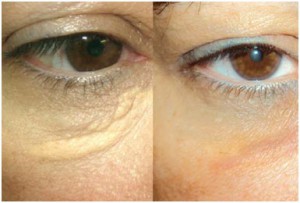 xanthelasma-300x203